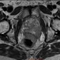 Understanding Prostate Cancer and the Role of MRI in Early Detection