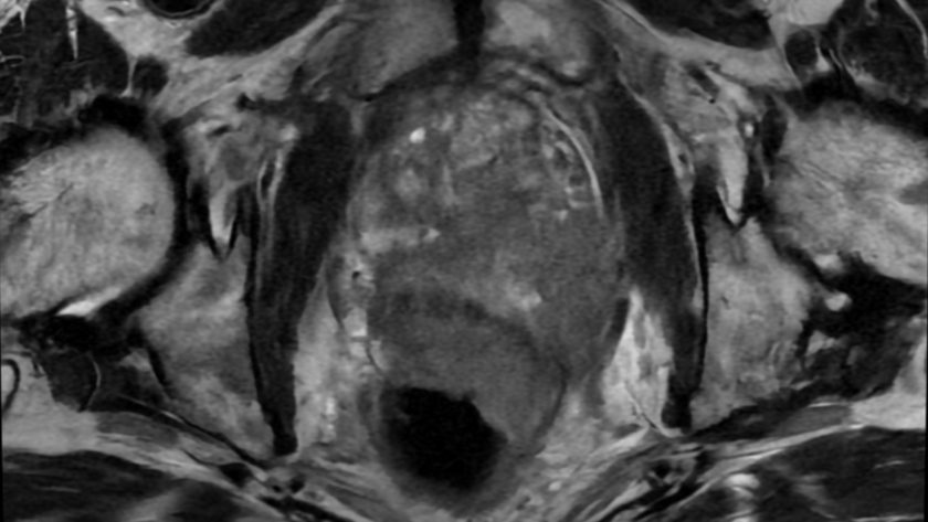 T2- weighted image of a prostate cancer