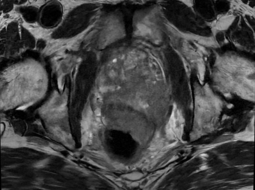 T2- weighted image of a prostate cancer